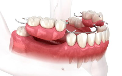 Complete and Partial Dentures