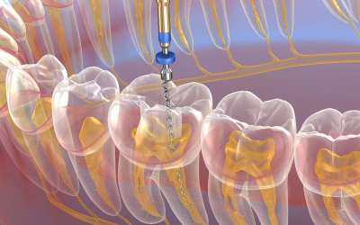 Root Canal Therapy