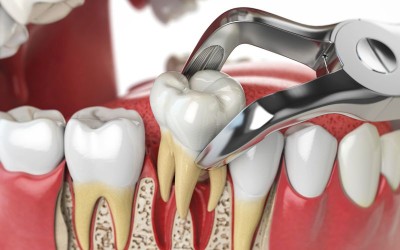 Tooth Extractions