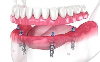 Denture Stabilization